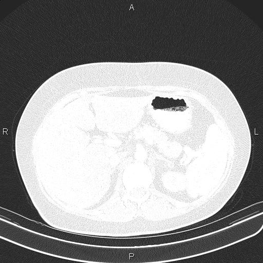 Aberrant right subclavian artery (Radiopaedia 87334-103629 Axial lung window 71).jpg