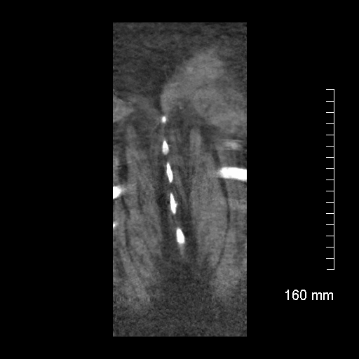 File:Aberrant right subclavian artery stenosis (Radiopaedia 52656-58670 B 80).jpg