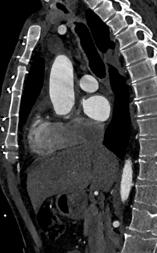Accessory left atrial appendage (Radiopaedia 81987-95968 Sagittal C+ arterial phase 37).jpg