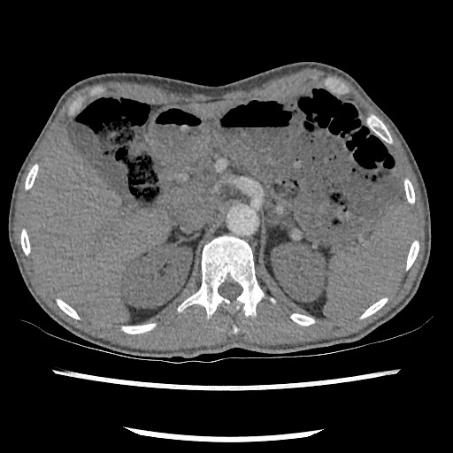 Accessory left horizontal fissure with lingular pneumonia (Radiopaedia 53763-59843 Axial C+ CTPA 93).jpg
