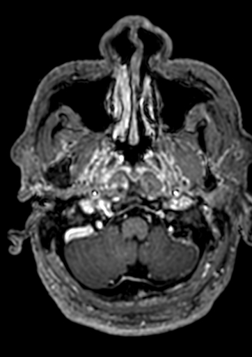 Accessory middle cerebral artery (Radiopaedia 73114-83828 Axial T1 C+ 170).jpg