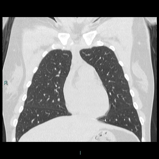 Accidental foreign body aspiration (seamstress needle) (Radiopaedia 77740-89983 Coronal lung window 44).jpg