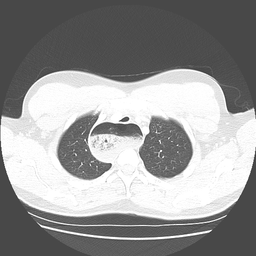 Achalasia (Radiopaedia 52507-58417 Axial lung window 12).jpg