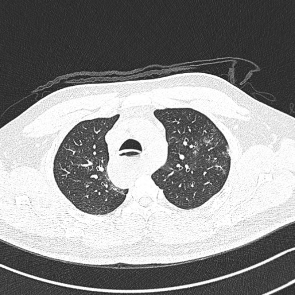 Achalasia with aspiration (Radiopaedia 55413-61845 Axial lung window 17).jpg