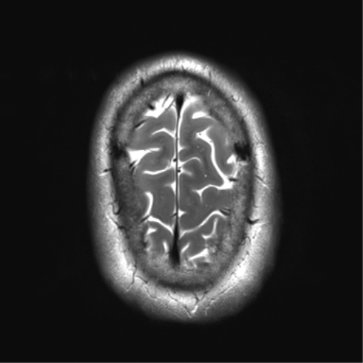 File:Achondroplasia (Radiopaedia 65109-74105 Axial T2 36).png