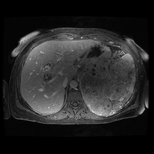 Acinar cell carcinoma of the pancreas (Radiopaedia 75442-86668 Axial T1 C+ fat sat 99).jpg