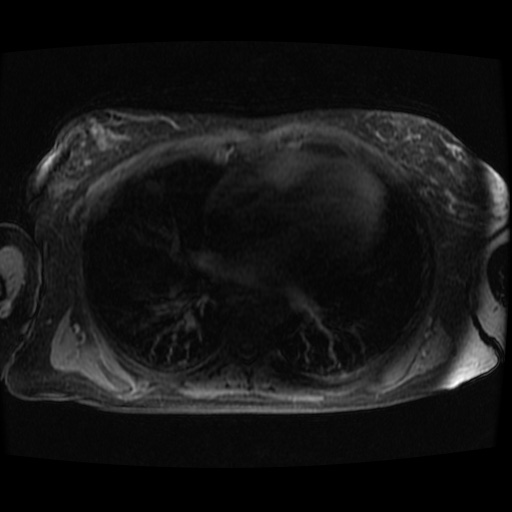 Acinar cell carcinoma of the pancreas (Radiopaedia 75442-86668 Axial late phase (~30 mins) 151).jpg