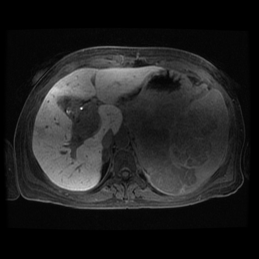 Acinar cell carcinoma of the pancreas (Radiopaedia 75442-86668 Axial late phase (~30 mins) 93).jpg