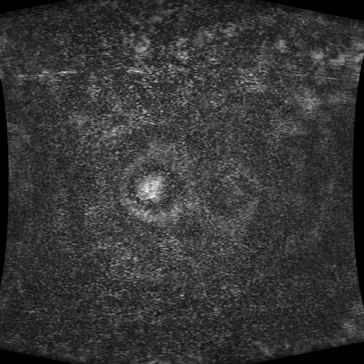 Acinar cell carcinoma of the pancreas (Radiopaedia 75442-86668 Coronal T1 C+ fat sat 195).jpg