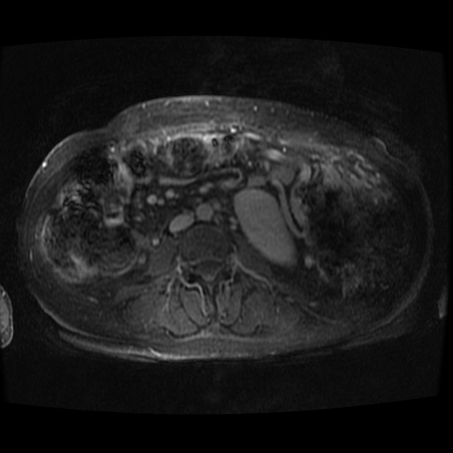 Acinar cell carcinoma of the pancreas (Radiopaedia 75442-86668 D 4).jpg