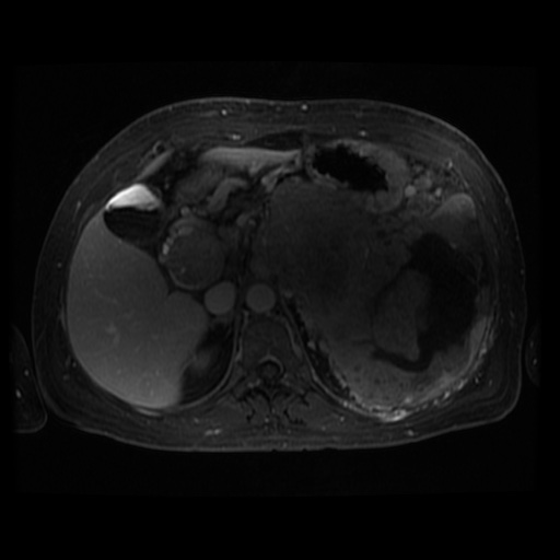 Acinar cell carcinoma of the pancreas (Radiopaedia 75442-86668 D 77).jpg