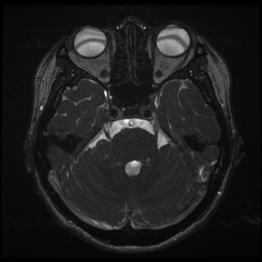 Acoustic neuroma (Radiopaedia 34049-35283 Axial 69).png