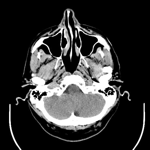 File:Acoustic schwannoma (Radiopaedia 29488-29982 AXIAL THICK non-contrast 7).jpg