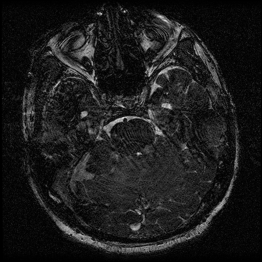 File:Acoustic schwannoma (Radiopaedia 39170-41387 Axial FIESTA 90).png