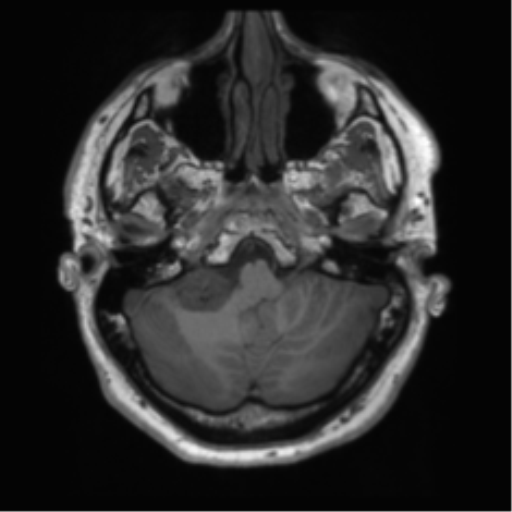 File:Acoustic schwannoma (Radiopaedia 50846-56358 Axial T1 12).png