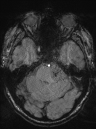 Acoustic schwannoma (Radiopaedia 55729-62281 Axial SWI 15).png