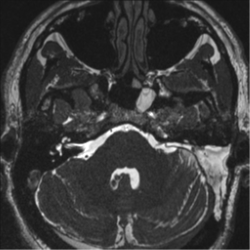 Acoustic schwannoma (translabyrinthine resection) (Radiopaedia 43570-46972 Axial CISS 29).png
