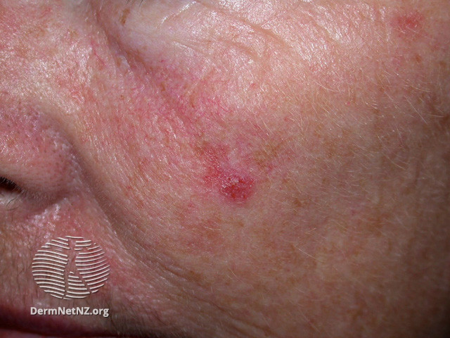Actinic Keratoses affecting the face (DermNet NZ lesions-ak-face-401).jpg