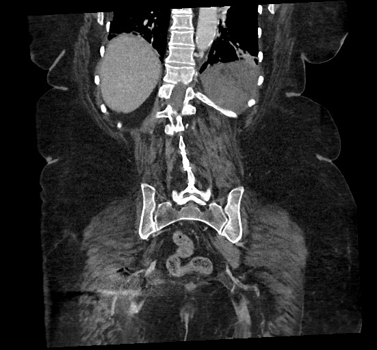File:Active renal extravasation with large subcapsular and retroperitoneal hemorrhage (Radiopaedia 60975-68796 Coronal C+ portal venous phase 119).jpg