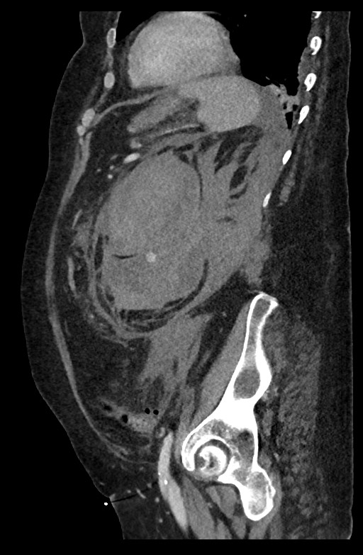 Active renal extravasation with large subcapsular and retroperitoneal hemorrhage (Radiopaedia 60975-68796 Sagittal C+ portal venous phase 77).jpg