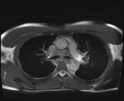 File:Active right ventricular cardiac sarcoidosis (Radiopaedia 55596-62100 Axial SSFP 16).jpg