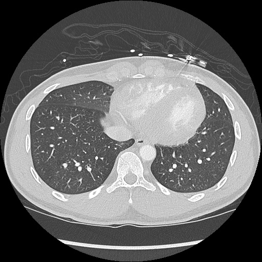 File:Active right ventricular cardiac sarcoidosis (Radiopaedia 55596-62101 Axial lung window 37).jpg