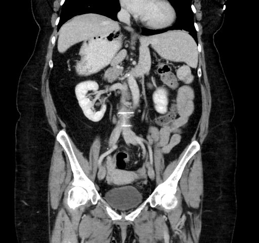Acute appendicitis, heterotaxy syndrome (Radiopaedia 66884-76202 Coronal C+ portal venous phase 64).jpg