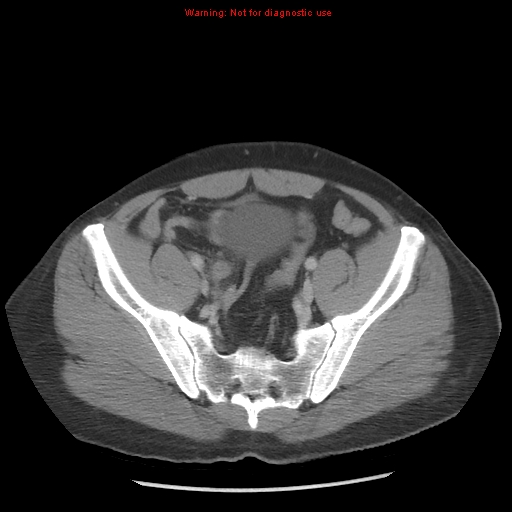 File:Acute appendicitis (Radiopaedia 10498-10973 Axial C+ portal venous phase 38).jpg