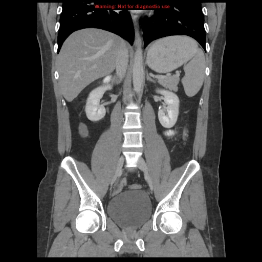 File:Acute appendicitis (Radiopaedia 10498-10973 F 25).jpg