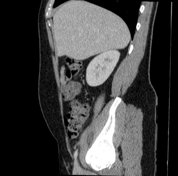 Acute appendicitis (Radiopaedia 38255-40270 Sagittal C+ portal venous phase 23).jpg