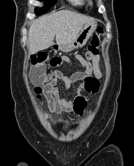 File:Acute appendicitis (Radiopaedia 48792-53822 Coronal C+ portal venous phase 65).jpg