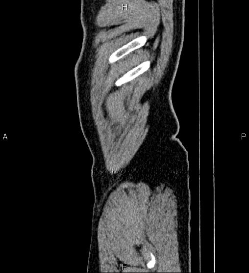 File:Acute appendicitis (Radiopaedia 84780-100240 Sagittal C+ portal venous phase 1).jpg