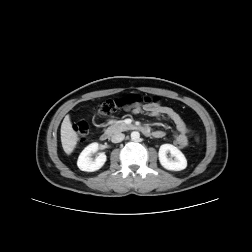 Acute appendicitis and COVID 19 pneumonia (Radiopaedia 76604-88380 Axial C+ portal venous phase 34).jpg