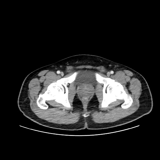 Acute appendicitis and COVID 19 pneumonia (Radiopaedia 76604-88380 Axial C+ portal venous phase 83).jpg