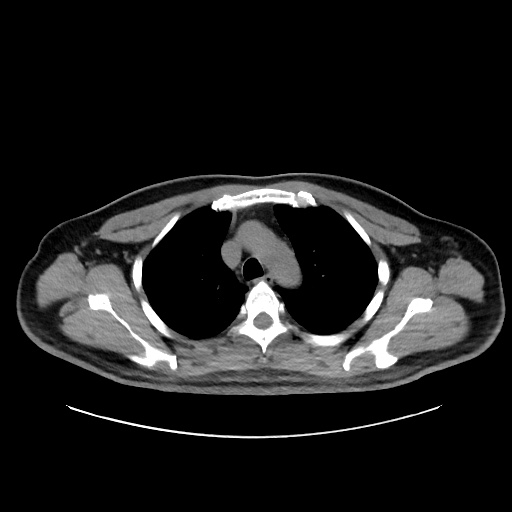 Acute appendicitis and COVID 19 pneumonia (Radiopaedia 76604-88380 Axial non-contrast 16).jpg