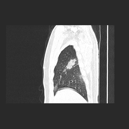 Acute appendicitis and COVID 19 pneumonia (Radiopaedia 76604-88380 Sagittal lung window 16).jpg