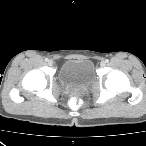 File:Acute appendicitis with CT arrowhead sign (Radiopaedia 21474-21411 Axial C+ portal venous phase 39).jpg
