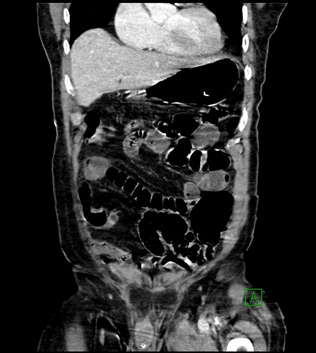 Acute arterial mesenteric ischemia (Radiopaedia 78238-90828 Coronal C+ portal venous phase 31).jpg