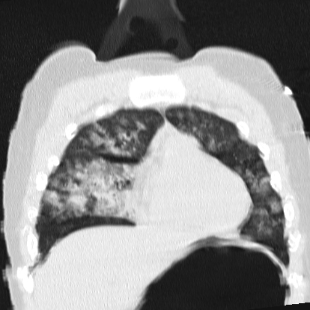Acute aspiration pneumonitis (Radiopaedia 33605-34703 Coronal lung window 26).jpg