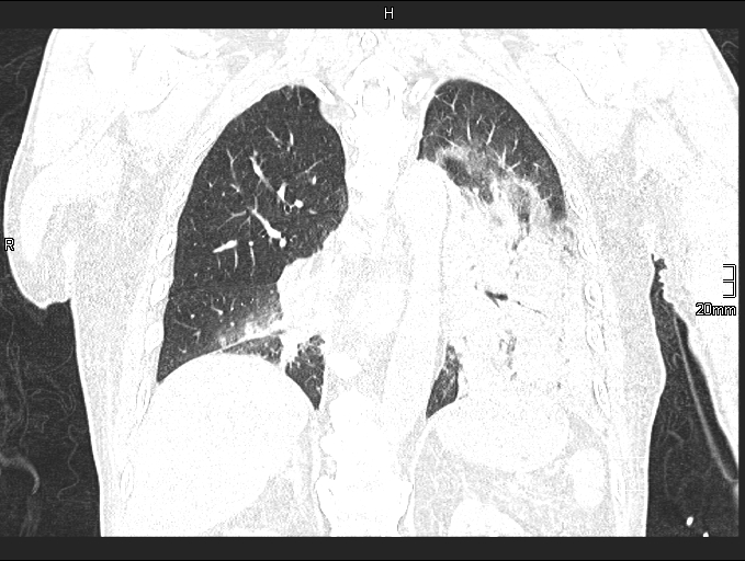 Acute aspiration pneumonitis (Radiopaedia 55642-62166 Coronal lung window 67).jpg