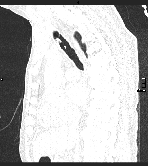 Acute aspiration pneumonitis (Radiopaedia 55642-62166 Sagittal lung window 82).jpg