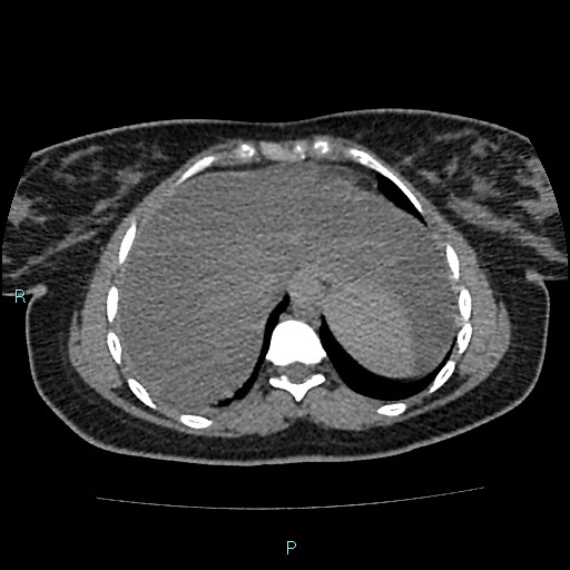 Acute bilateral pyelonephritis (Radiopaedia 37146-38881 Axial non-contrast 11).jpg