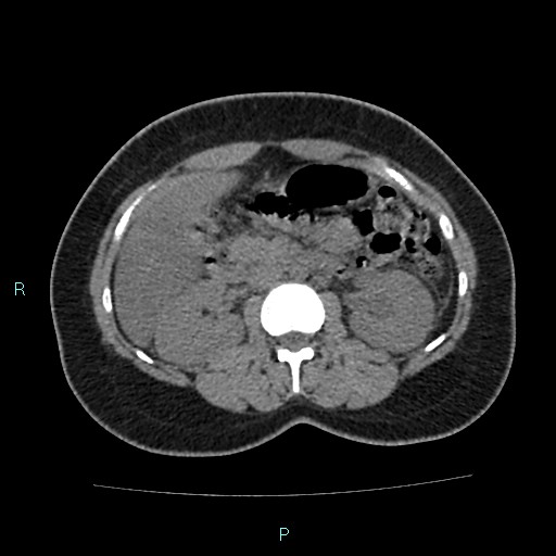 Acute bilateral pyelonephritis (Radiopaedia 37146-38881 Axial non-contrast 44).jpg