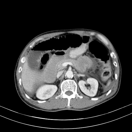 Acute bowel ischemia (Radiopaedia 87695-104114 Axial C+ portal venous phase 29).jpg
