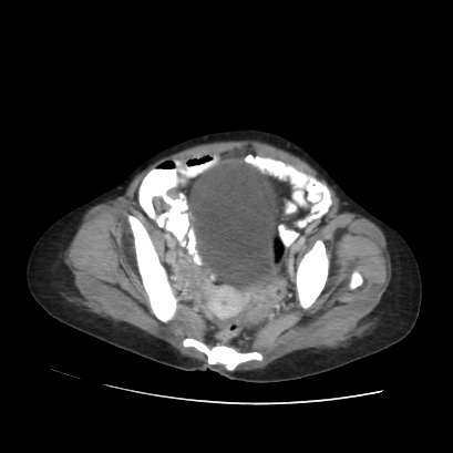 File:Acute calculous cholecystitis in patient with osteopetrosis (Radiopaedia 77871-90159 Axial C+ portal venous phase 68).jpg