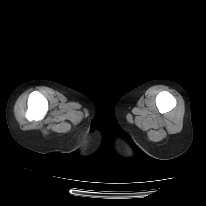 File:Acute calculous cholecystitis in patient with osteopetrosis (Radiopaedia 77871-90159 Axial non-contrast 91).jpg