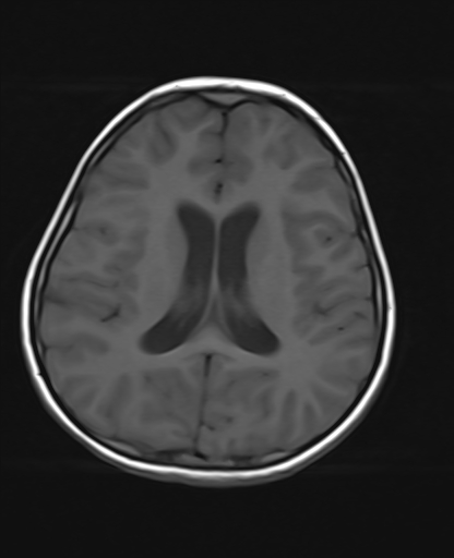 File:Acute cerebellar ataxia (Radiopaedia 61487-69446 Axial T1 14).jpg