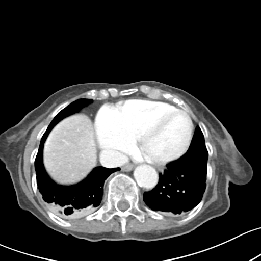 Acute cholecystitis with contained perforation (Radiopaedia 47328-51907 Axial C+ portal venous phase 6).png
