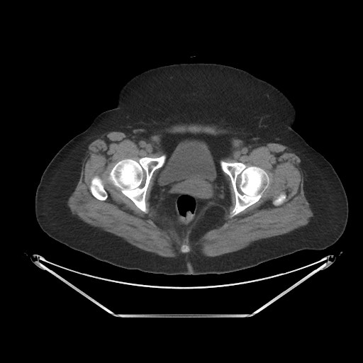 File:Acute cholecystitis with tensile fundus sign (Radiopaedia 71394-81723 Axial non-contrast 113).jpg