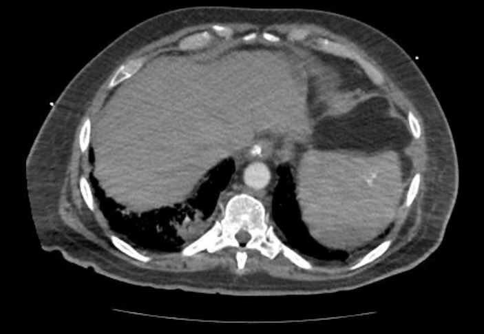 File:Acute cor pulmonale (ultrasound) (Radiopaedia 83508-98818 Axial C+ CTPA 69).jpg